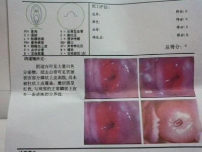 盆腔积水有什么症状 盆腔积水怎么形成的 盆腔积水有什么症状