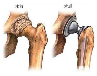 股骨头坏死治疗好方法 股骨头坏死好的治疗方法