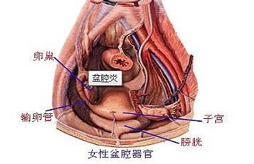 慢性盆腔炎吃什么药 慢性盆腔炎吃什么药好得快 慢性盆腔炎治疗方法