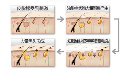 化妆堵塞毛孔起粉刺 化妆会堵塞毛孔吗