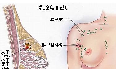 预防肿瘤的生活方式 乳瘤是怎么形成的 乳瘤的预防方式