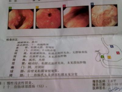 进食后右上腹部隐痛 吃饭后右上腹部隐痛的原因分析