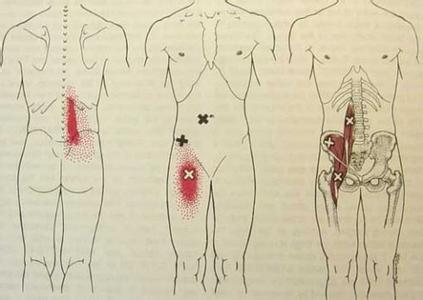 腰臀肌筋膜炎的症状 腰肌筋膜炎治疗方法