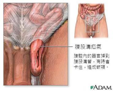 疝气的成因 疝气是什么形成的 疝气的成因和治疗