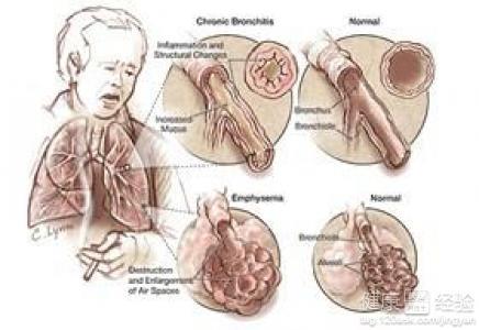 肺气肿吃什么食物 肺气肿吃什么好_治疗肺气肿的食物
