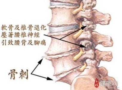 骨质增生有效治疗方法 骨质增生如何治疗_骨质增生有效的治疗方法