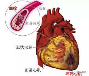 脑梗吃什么食物好得快 心梗脑梗吃什么好