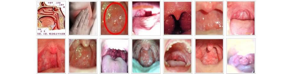 咽炎的危害 咽炎是如何形成的 咽炎有什么危害