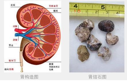 治疗肾结石的偏方 肾结石怎么治 肾结石的治疗偏方