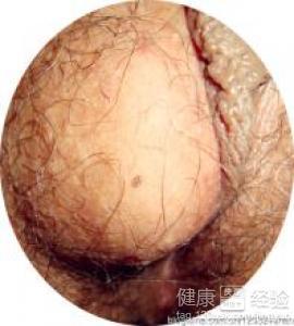 前庭大腺囊肿吃什么药 前庭大腺囊肿吃什么药_治疗前庭大腺囊肿的药