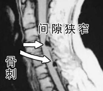 颈椎骨质增生治疗方法 颈椎骨质增生有什么好的治疗方法