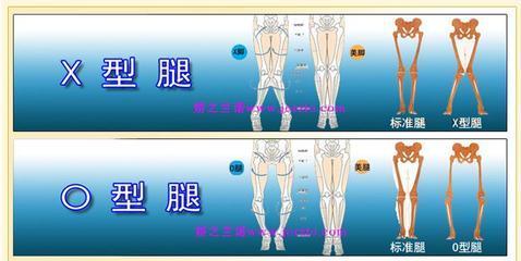 罗圈腿是怎么形成的 罗圈腿是怎么形成的 罗圈腿的形成原因