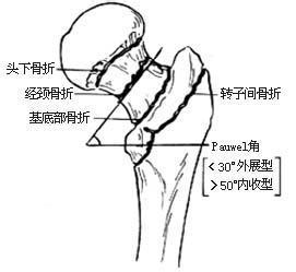 股骨头骨折是几级残疾 股骨头骨折治疗方法