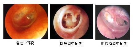 中耳炎耳鸣怎么治疗 中耳炎耳鸣是怎么回事