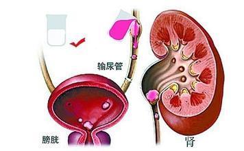 肾积水的表现 肾积水是怎样形成的 肾积水的表现和治疗