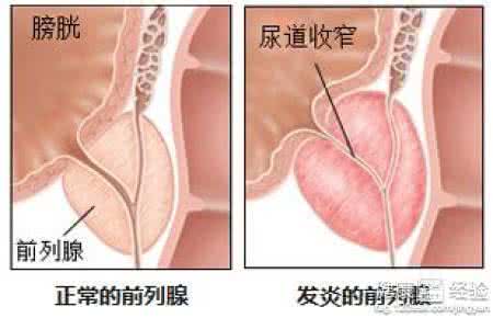 真菌性前列腺炎的治疗 真菌性前列腺炎治疗方法