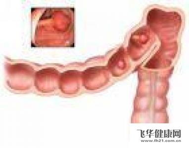 直肠癌形成原因 直肠癌形成的原因 直肠癌有什么症状