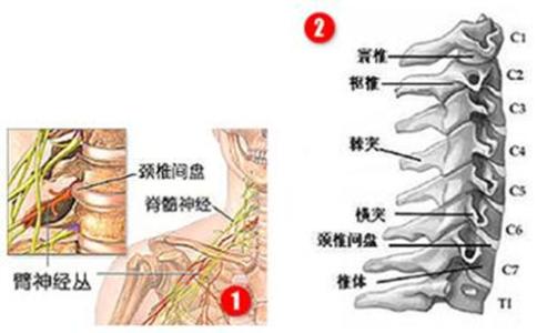 怎么方法治疗颈椎病好 颈椎病是怎么形成的 颈椎病的治疗方法