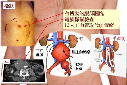 脑动脉瘤的治疗方法 颈部动脉瘤如何治疗 颈部动脉瘤治疗方法