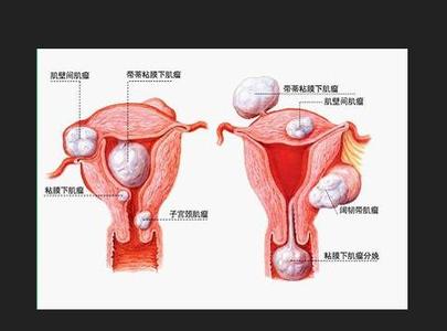 更年期功血的治疗方法 什么是更年期功血 更年期功血疾病病因 更年期功血治疗