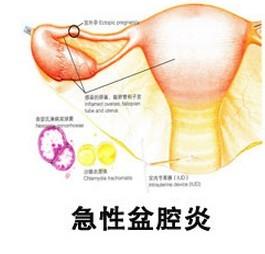 盆腔炎有什么症状 盆腔炎怎么治疗