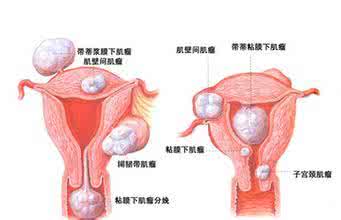 慢性盆腔炎影响生育吗 慢性盆腔炎会影响生育吗 慢性盆腔炎的危害