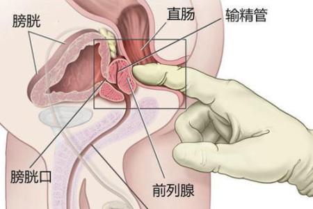 治疗前列腺炎的偏方 前列腺怎么治 前列腺的治疗偏方