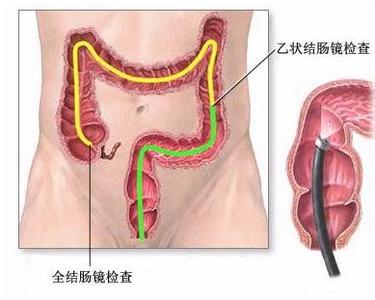 结肠癌和直肠癌的区别 什么是结肠直肠癌 结肠直肠癌病因 结肠直肠癌治疗