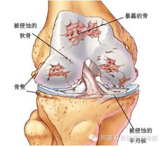 滑膜炎的原因 滑膜炎的原因有哪些