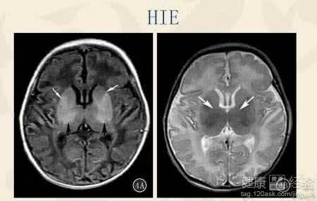 新生儿胆红素脑病 新生儿胆红素脑病怎么预防