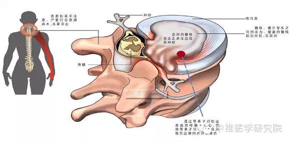 颈椎病病因病理 颈椎病的病理病因是什么