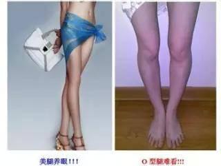 o型腿要怎么治疗 怎么治疗0型腿