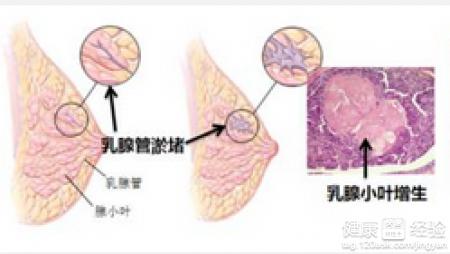 中医治疗小叶增生 小叶增生怎么形成的 小叶增生中医治疗