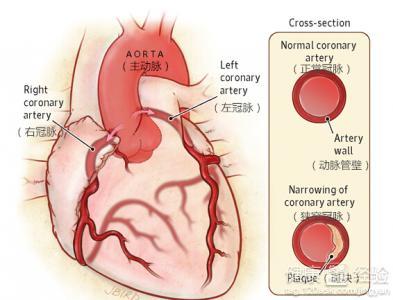导致冠心病的主要原因 导致冠心病的原因