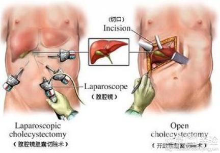 胆囊炎疼痛位置图 胆囊炎最好治疗方法