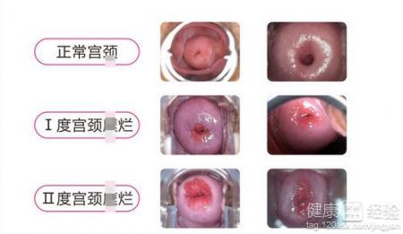 轻度宫颈糜烂最佳治疗 治疗轻度宫颈糜烂的最佳方法