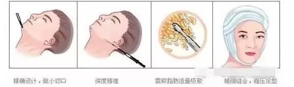 微创面部吸脂 微创面部吸脂手术