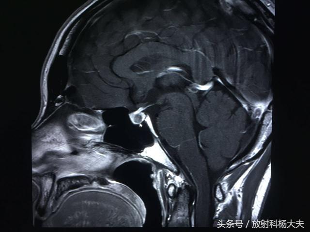 38岁女性停经，不是怀孕，大夫查完妇科，为啥要做头部MRI?